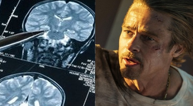 Prosopagnosia, cosa è la malattia di Brad Pitt che impedisce di riconoscere i volti