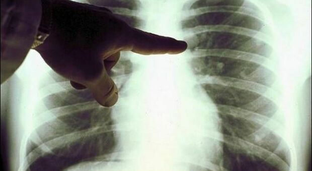 Tumore polmone, una nuova cura aumenta la sopravvivenza: 3 pazienti su quattro vivi dopo 4 anni dalla malattia