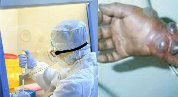 Marburg, il nuovo virus fa paura: sintomi simili all'Ebola: è altamente infettivo