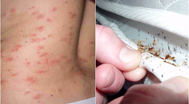 Cimici da letto a Roma, l'esperto: «Punture scambiate per quelle di zanzara, rischio choc anafilattico»