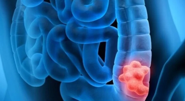 Tumore al colon, una ricerca le cellule responsabili della recidiva del cancro. «Speranza per milioni di malati»