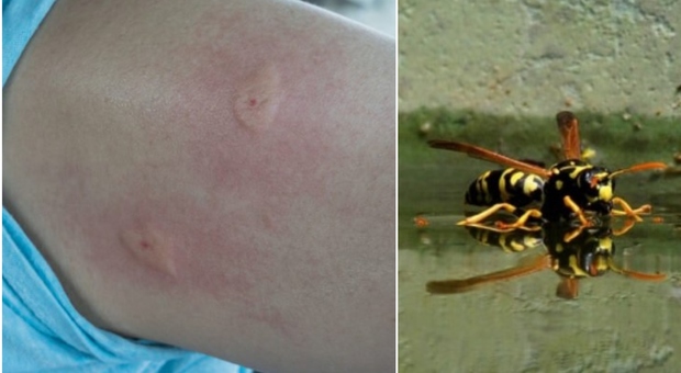 Punta da una vespa, donna muore per choc anafilattico: aveva 63 anni
