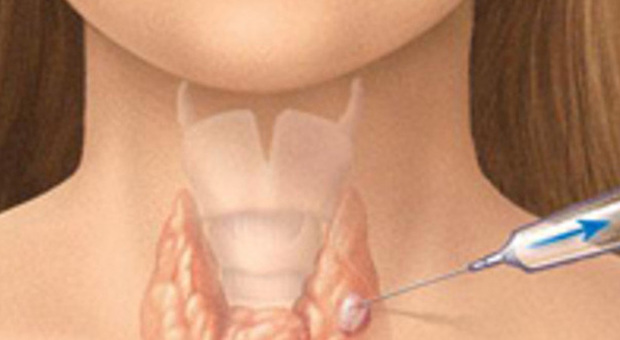 Settimana mondiale della tiroide: in Campania molta disinformazione e scarsa prevenzione