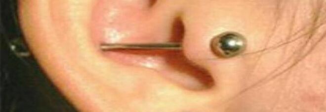Orecchio blu dopo il piercing, la rara infezione che ha colpito una ragazza inglese di 22 anni. I medici: «Mai visto nulla di simile»