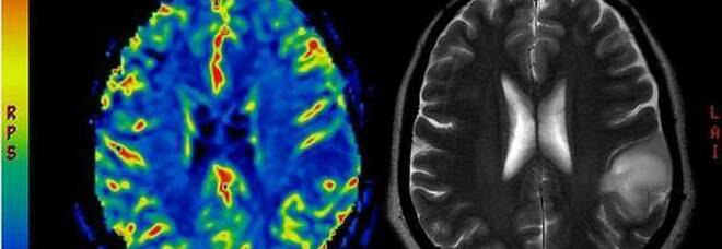Tumore al cervelo, efficace un mix di farmaci immunoterapici: i risultati di uno studio di ricerca di Siena