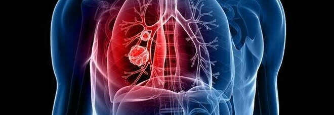 Tumore al polmone, lo screening riduce il tasso di mortalità del 35%