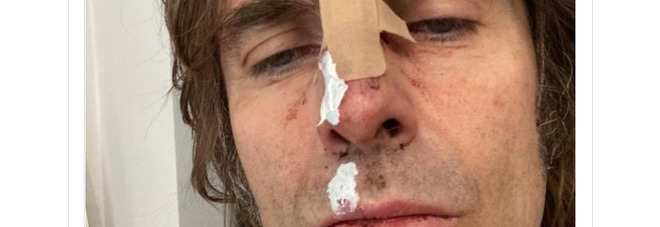Liam Gallagher cade dall'elicottero e si ferisce il volto: «Chi ha detto che il Rock è morto?»