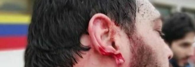 Rugby, orecchio staccato con un morso: condannato giocatore dell'Oderzo. La vittima: «Mai ricevuto scuse». L'omertà del club di Treviso