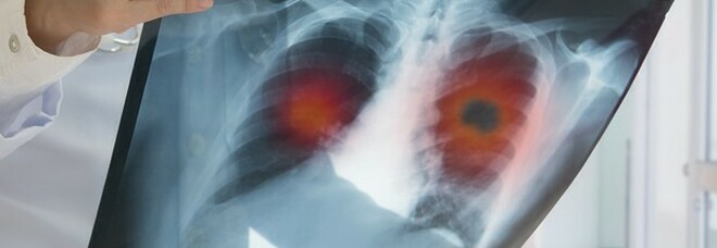 Tumore al polmone, scoperti quattro sottotipi di adenocarcinoma: la ricerca italiana