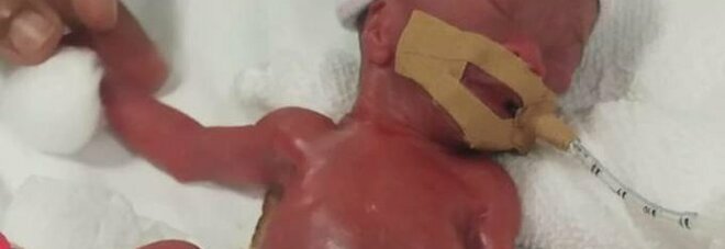 La bambina prematura più piccola del mondo è stata dimessa dopo 13 mesi di cure presso un ospedale di Singapore