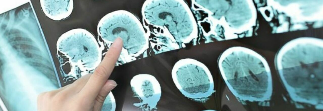 Alzheimer, un farmaco rallenta il declino cognitivo. «Svolta epocale, malattia potrebbe essere curabile»