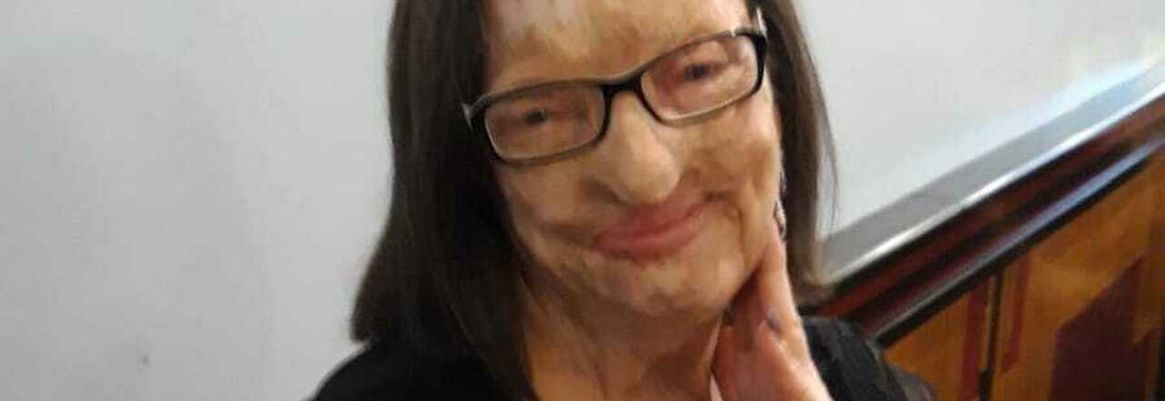 Filomena Lamberti, 64 anni, prima donna sfigurata dall'acido dal marito